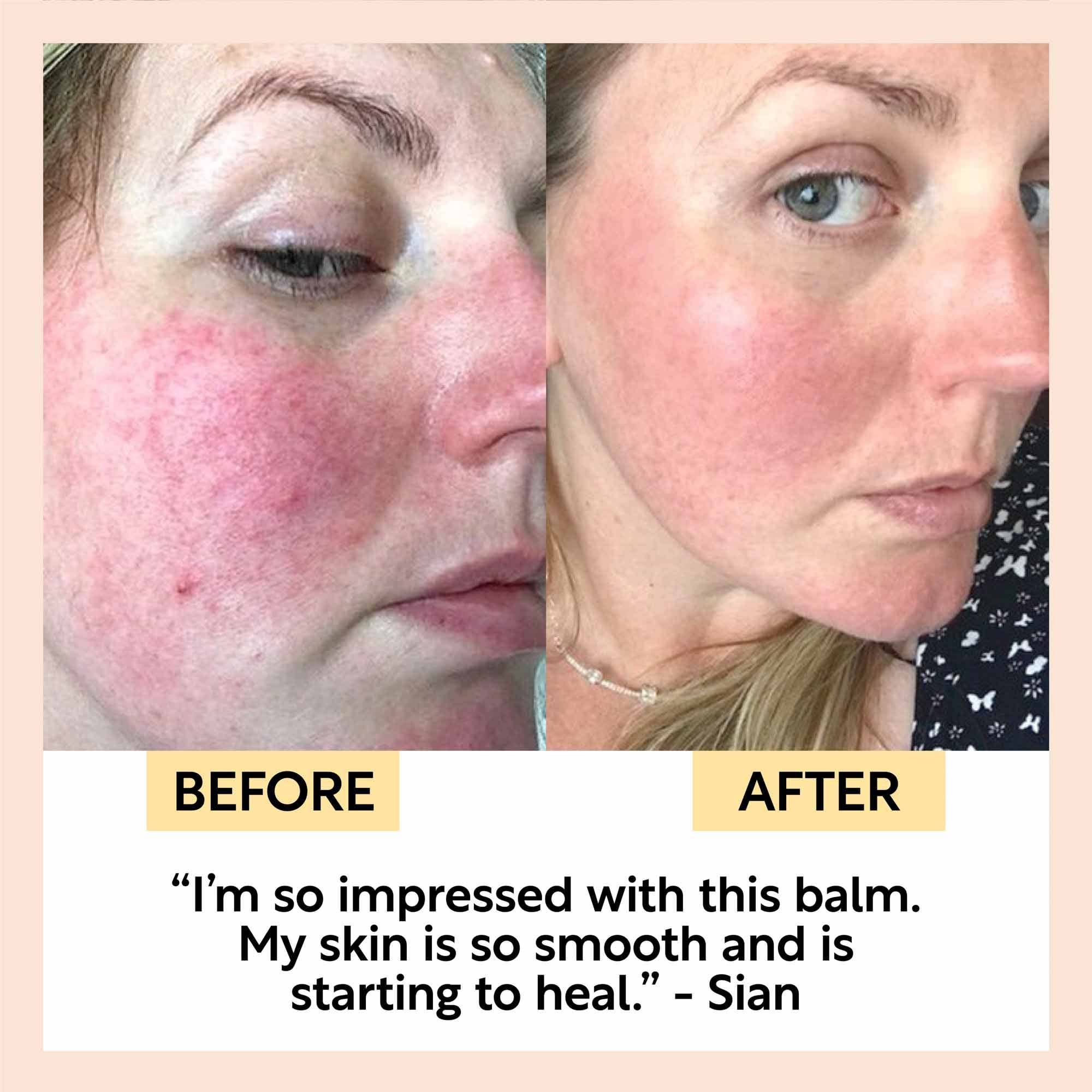 Before and after comparison of a person's face with visible skin conditions, using a balm.